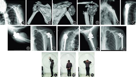 A 70 Year Old Male Patient With Left Proximal Humeral Comminuted