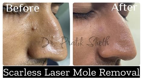 Laser Mole Removal In Rajkot Safe And Effective Treatment