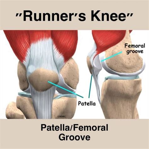 Running With Patellofemoral Syndrome A Guide To Manage And Thrive