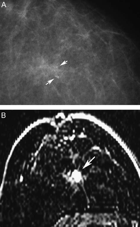 Asymptomatic 60 Year Old Woman A Mammogram Shows A Small Group Of Download Scientific