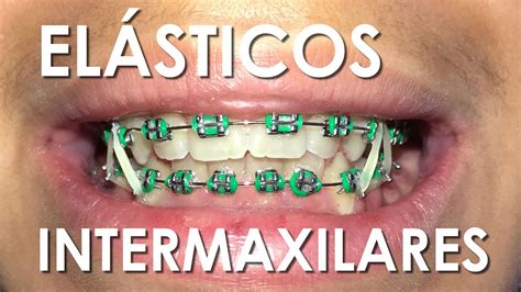 ElÁsticos Conoce Los Tipos De Elásticos Intermaxilares Youtube