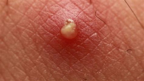 Why Does My Bum Cheek Burn at Andrew Quesada blog