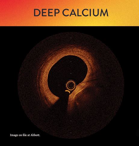 Optical Coherence Tomography Oct Calcified Lesions Abbott