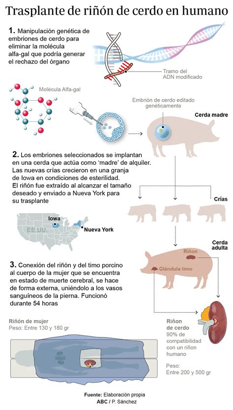 As Se Realiz El Primer Trasplante Del Ri N De Un Cerdo A Un Humano