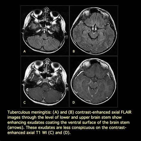 MRI BLOG: Contrast-enhanced FLAIR for Infectious Leptomeningitis