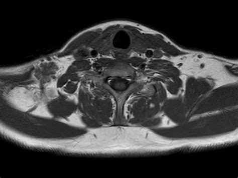 Brachial Plexus With A Hemangioma Philips Mr Body Map