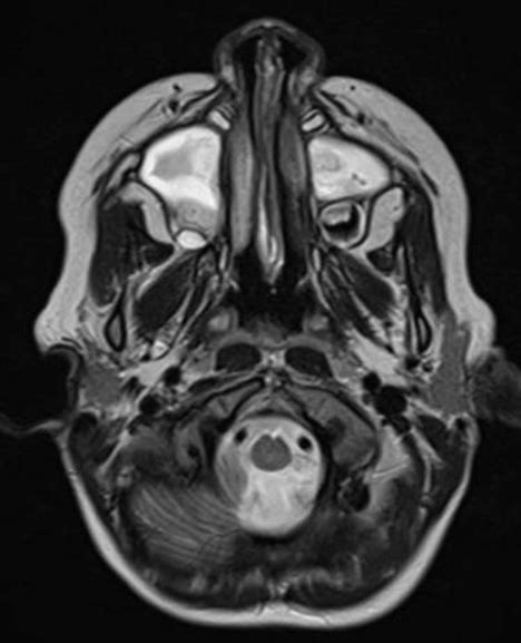 Septal Incision And Nasal Abscess Was Drained Download Scientific