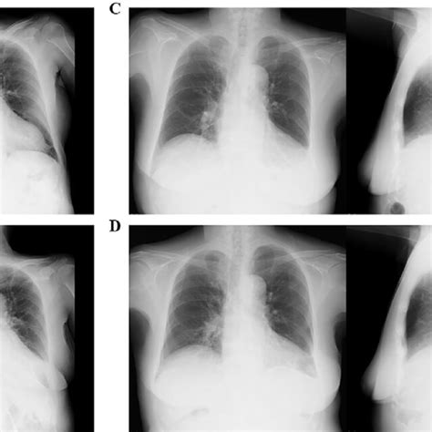 Figure1a Chest X Ray On Admission B Chest X Ray On Development Of Download Scientific