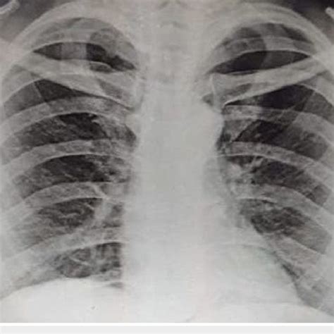 Chest X Ray Showing Diffuse Patchy Ground Glass Opacities In The Download Scientific Diagram