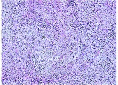 Tumoral Proliferation Made Of Bland Looking Spindle Cells Arranged In