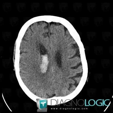 Radiology Case Hematoma Ct Mri Diagnologic