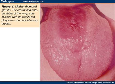 Median Rhomboid Glossitis Histology