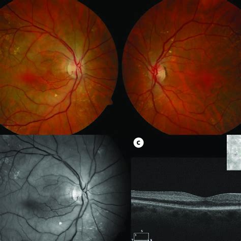 A Color Fundus Photographs Demonstrating Diffuse Retinal Edema Sparing