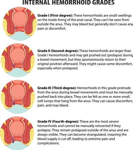 Hemorrhoids Vector Images Over 720