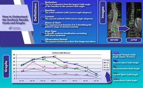 Scoliosis Before And After Treatment Results Scoliosis Care Centers