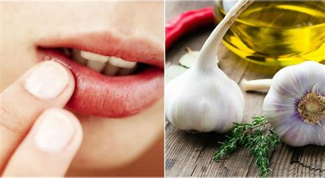 7 Home Remedies For Lip Infection