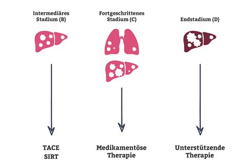 Leberkrebs Diagnose Und Therapie I Das K Wort