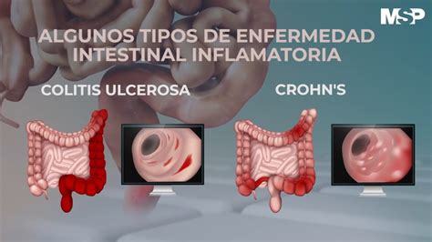 C Mo Tratar Las Enfermedades Inflamatorias Del Intestino