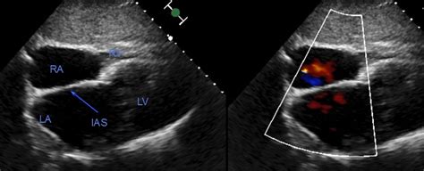 Subcostal four chamber view – Echocardiography – All About ...