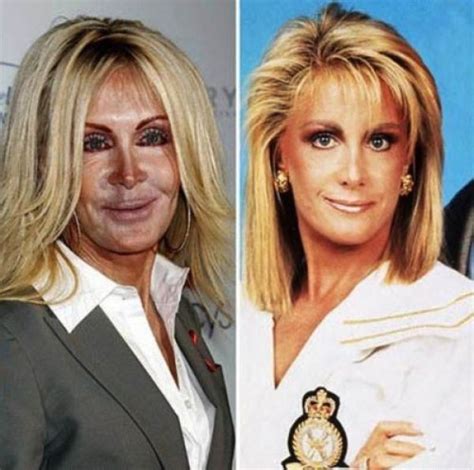 The Horrors Of Terrible Plastic Surgery 40 Pics Izismile