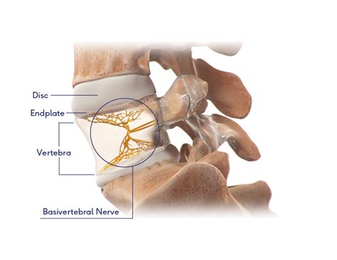 Explore The Intracept Procedure For Chronic Low Back Pain