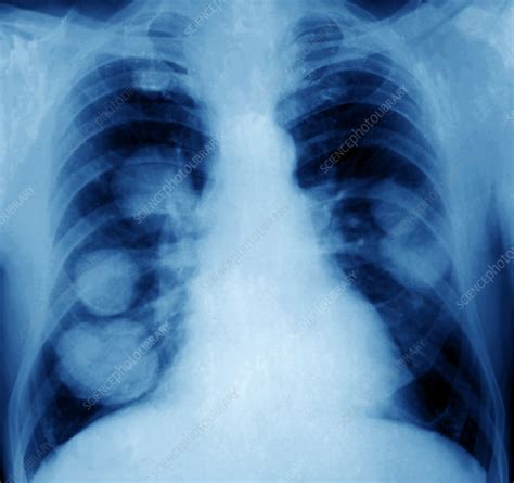 Lung Cancer X Ray Stock Image M1340620 Science Photo Library