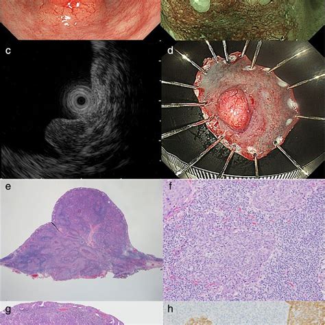 Colonoscopy Revealed A Mmsized Submucosal Tumor Smt In The Lower