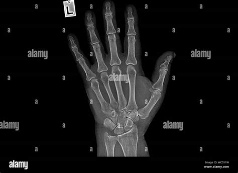 Hand X Ray High Resolution Stock Photography And Images Alamy