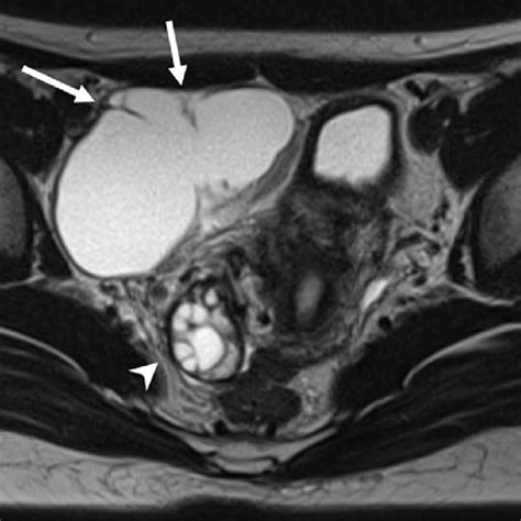 Pdf Isolated Fallopian Tube Torsion Diagnosed And Treated With