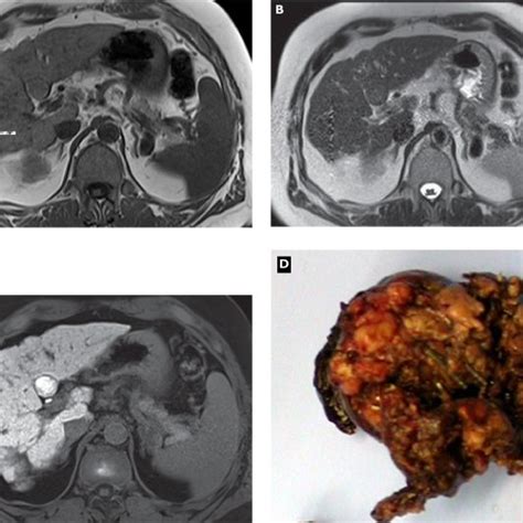 Well Differentiated Hepatocellular Carcinoma Hcc Plain T1 Weighted Download Scientific