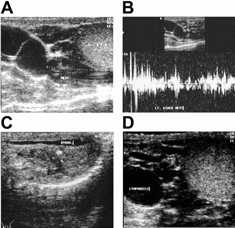 Composite Of Scrotal Ultrasound Findings In Different Men Before