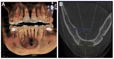 Icd 10 Code For Molar Abscess