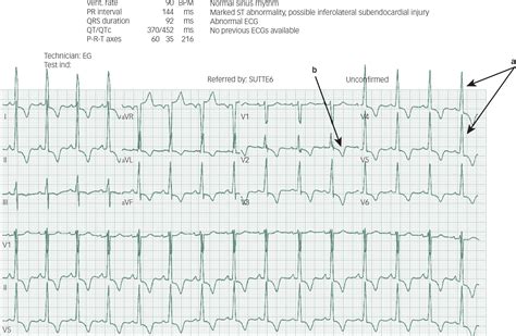 Clozapine In A Patient With Treatment Resistant Schizophrenia And