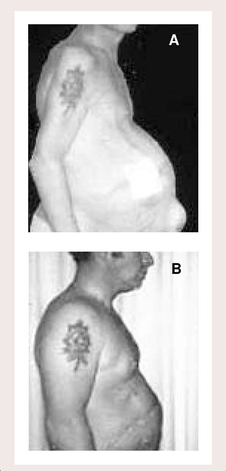 A Patient With Alcoholic Cirrhosis Who Shows Ascites An Umbilical