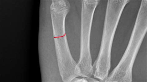 5th Metacarpal Fracture Xray 20 Youtube