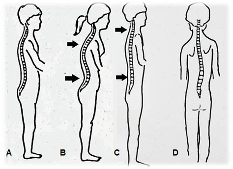 A Curvas Fisiol Gicas Da Coluna Vertebral B D Principais