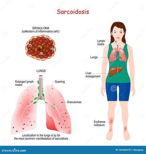 Granulomas Cartoons, Illustrations & Vector Stock Images - 30 Pictures