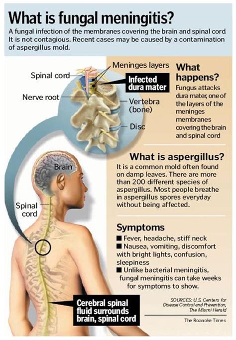 Fungal Meningitis What Has Been Going Around Due To Contaminated