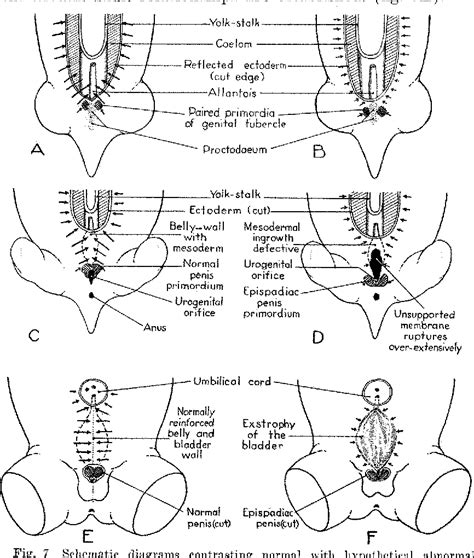 Figure 7 From The Genesis Of Exstrophy Of The Bladder And Epispadias Semantic Scholar