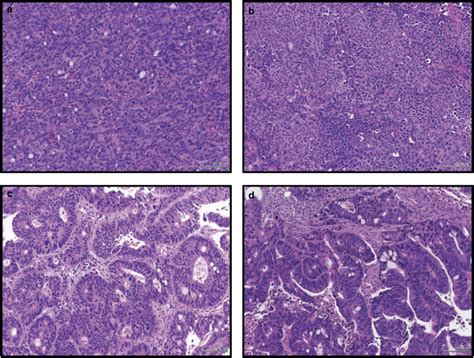 Patient Derived Xenograft Pdx Models Of Colorectal Cancer