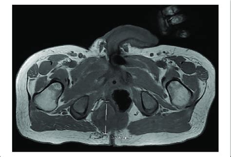 Magnetic Resonance Imaging Mri Of The Pelvis Showing The Axial View