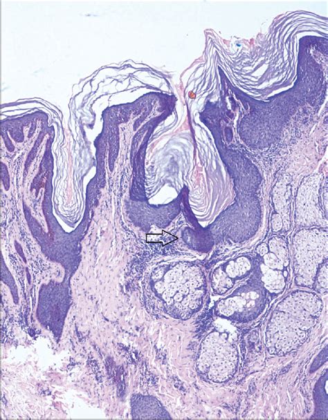 Phacomatosis Pigmentokeratotica A Very Rare Twin Spotting Phenomenon