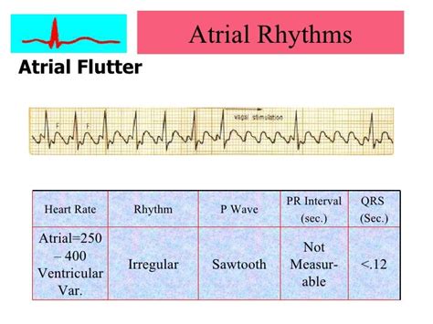 Cardiac Arrhythmias