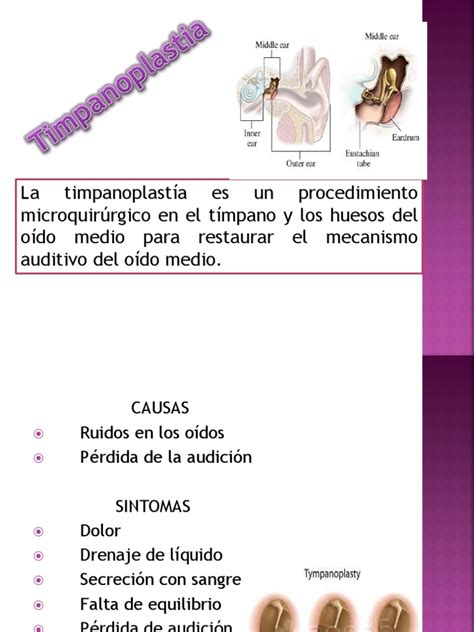 Timpanoplastia Pdf Oído Otología