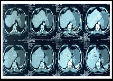 Lobulated heterogeneous soft tissue mass lesion involving... | Download ...