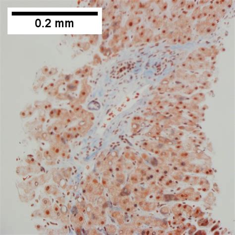 Congestive Hepatopathy Libre Pathology