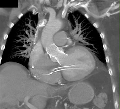 Cta In Patient With Prior Tavr Repair Of Aortic Valve Cardiac Case