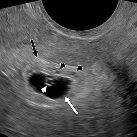 Gestational Trophoblastic Disease Clinical And Imaging Features