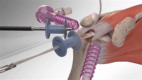 Arthroscopic Rotator Cuff Surgery Youtube At Aaron Smith Blog