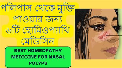 Best Homeopathy Medicine For Nasal Polyps পলিপাস থেকে মুক্তি পাওরার